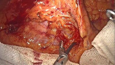 A new approach: Laparoscopic right hemicolectomy with priority access to small bowel mesentery